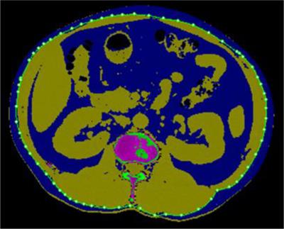 The Optimal Axial Anatomical Site for a Single-Slice Area to Quantify the Total Volume of Visceral Adipose Tissue in Quantitative CT